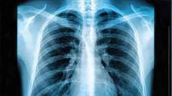 Woman agrees to collude with boyfriend against insurance after bone injury