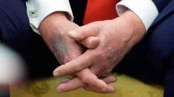 Trump’s hand bruises re-ignite speculation about his health