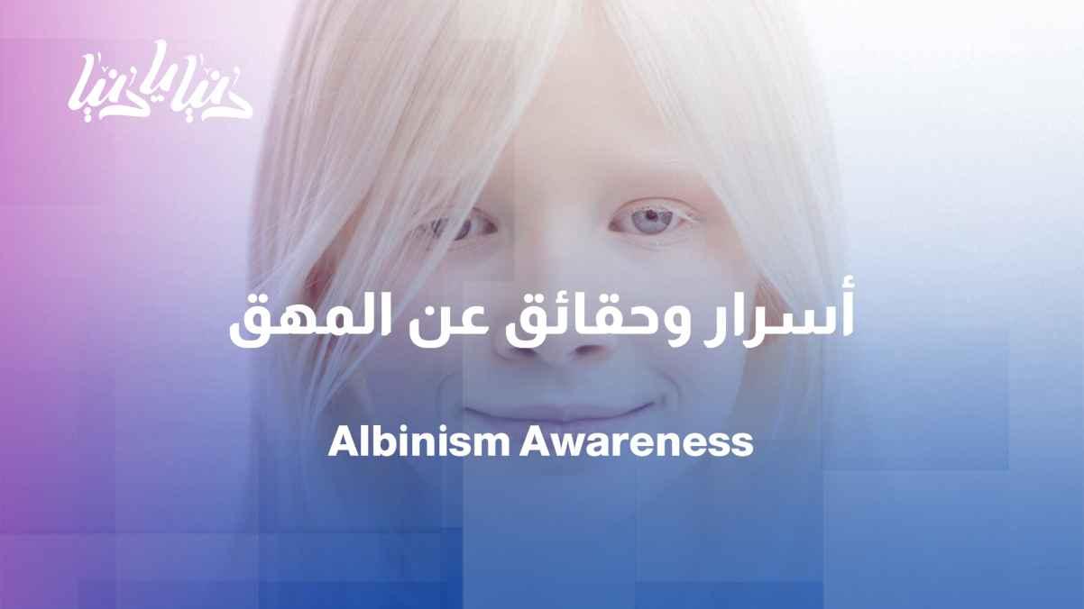 International Albinism Awareness Day: Breaking stereotypes and building understanding.