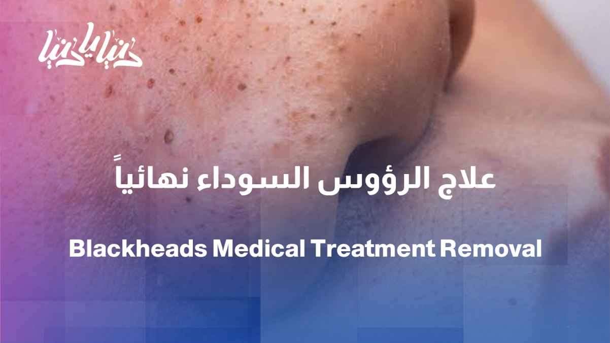 Why do blackheads appear? And what is the correct way to get rid of them?