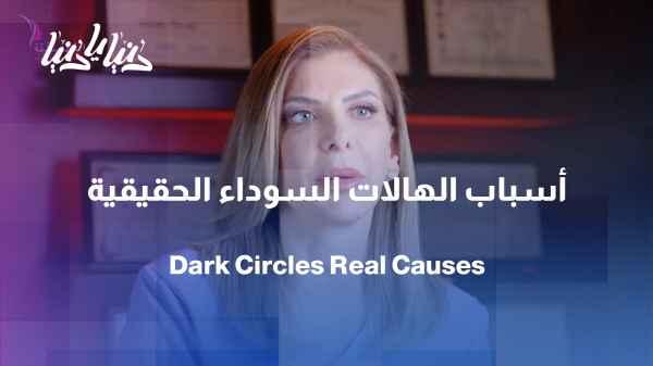 Are dark circles caused solely by a lack of sleep?