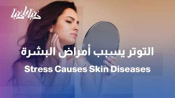 When your skin translates your stress... inflammations and viruses appear on the skin