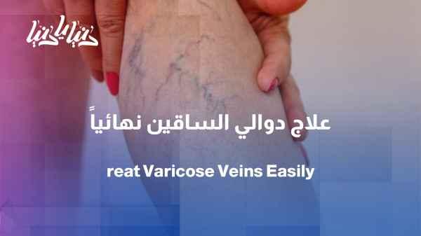 Varicose veins... symptoms that should not be ignored